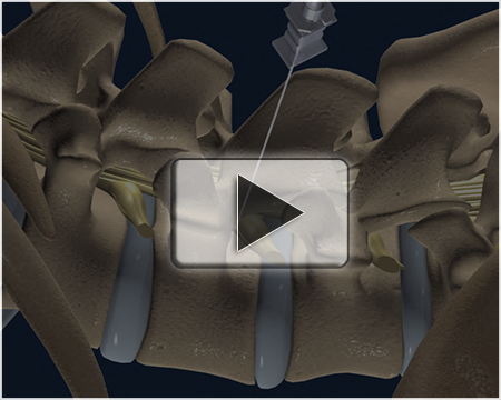 Cervical spine epidural steroid injection video