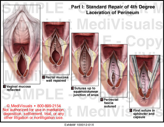 Medivisuals Standard Repair Of Th Degree Laceration Of Perineum