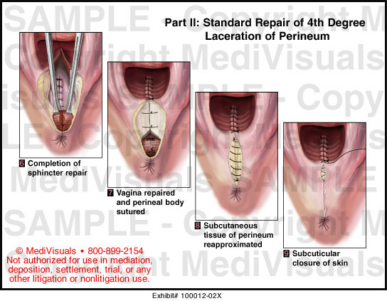 Perineal Tear 4th Degree