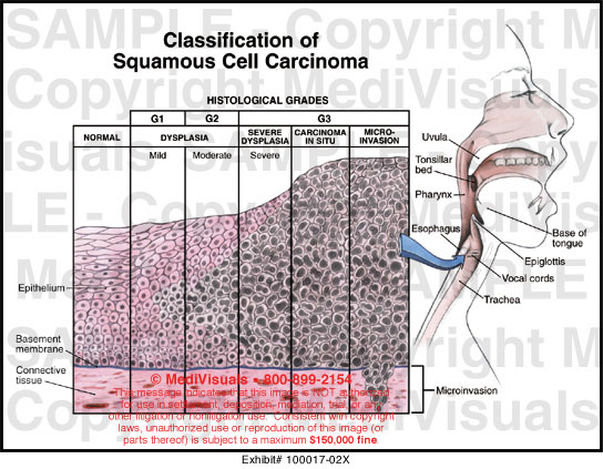 Classification Of Squamous Cell Carcinoma Medical Illustration