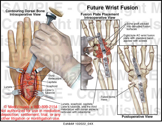 Future Wrist Fusion Medical Exhibit Medivisuals