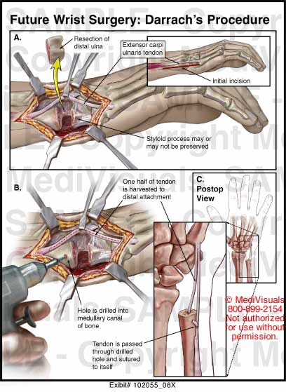 Future Wrist Surgery Darrach S Procedure Medical Exhibit Medivisuals