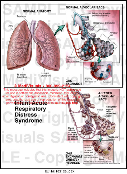 Infant Acute Respiratory Distress Syndrome Medical Exhibit Medivisuals