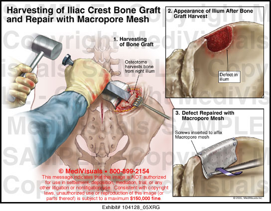 iliac crest bone graft