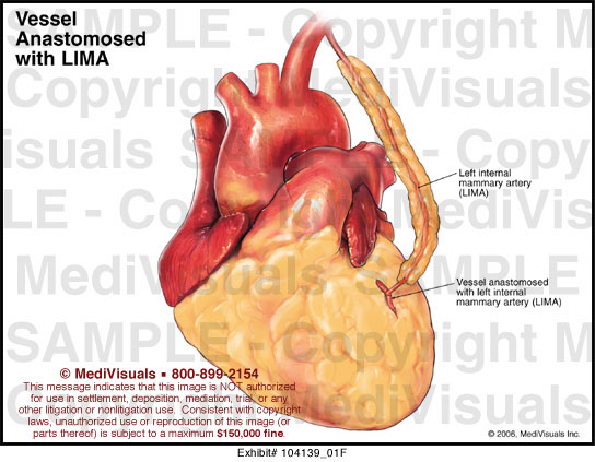 vessel-anastomosed-with-lima-medical-exhibit-medivisuals