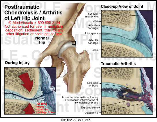 Posttraumatic Chondrolysis and Arthritis of Hip Joint