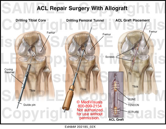 Acl Repair Surgery With Allograft Medical Illustration Medivisuals