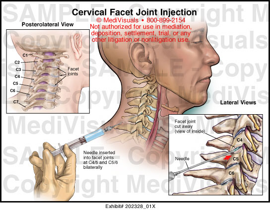 Cervical Facet Joint Injection Medical Illustration Medivisuals