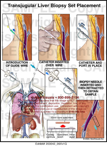 transjugular-liver-biopsy-set-placement-medical-exhibit-medivisuals