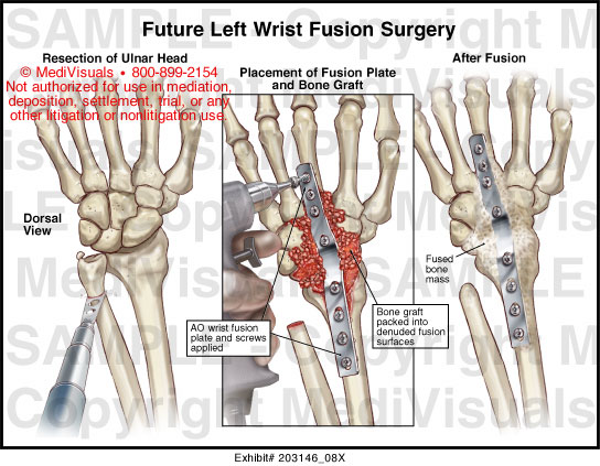 Future Left Wrist Fusion Surgery Medical Illustration