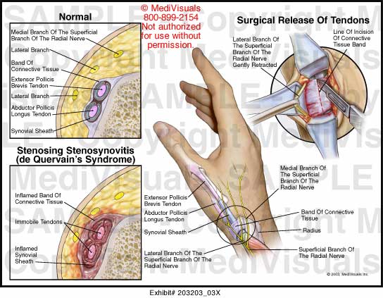 Medivisuals Surgical Release Of Tendons Medical Illustration