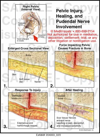 Does Pudendal Nerve Heal