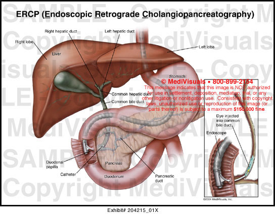 ercp-procedure-indications-recovery-complications