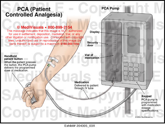 Patient-Controlled Analgesia Pumps