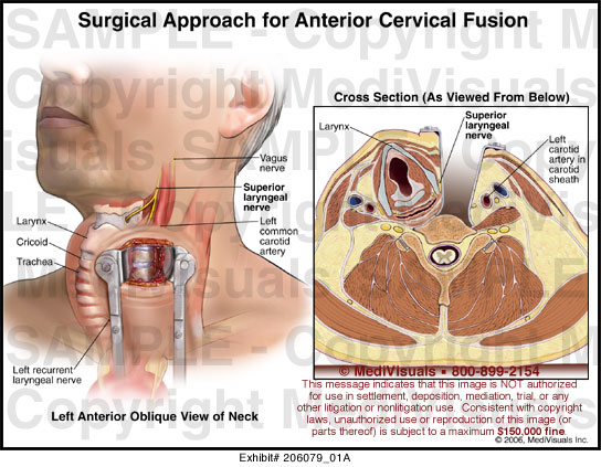 The anterior cervical approach to the spine (cross-sectional view)