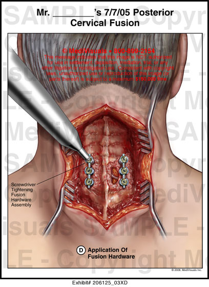 Medivisuals Posterior Cervical Fusion Medical Illustration