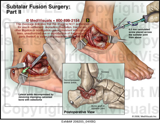 Medivisuals Subtalar Fusion Surgery Part Ii Medical Illustration