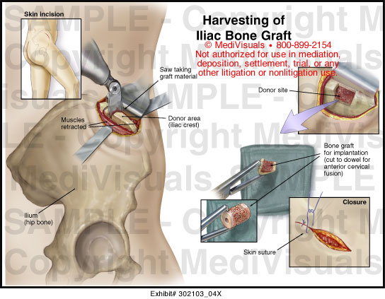 Harvesting of Iliac Bone Graft Medical Illustration Medivisuals