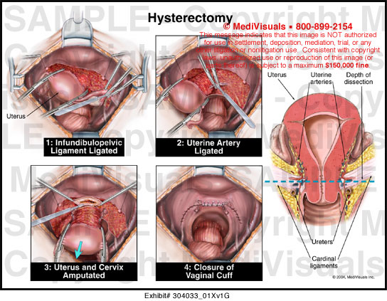 Hysterectomy Medical Exhibit Medivisuals
