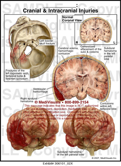 Cranial And Intracranial Injuries Medical Exhibit Medivisuals