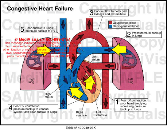 Congestive Heart Failure Medical Illustration Medivisuals