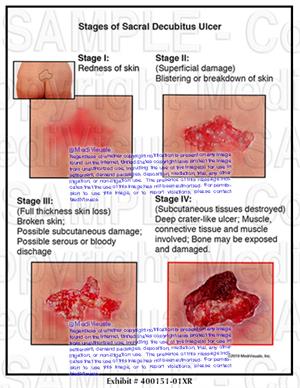 ulcer sacral decubitus stages medivisuals1