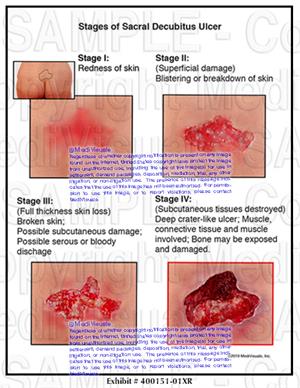 Medivisuals Stages Of Sacral Decubitus Ulcer Medical Illustration