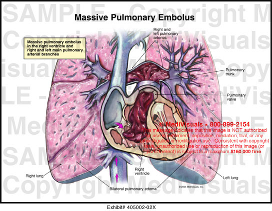 massive pulmonary embolism