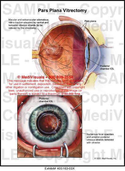 Medivisuals Pars Plana Vitrectomy Medical Illustration