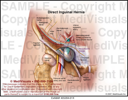 Direct Inguinal Hernia Medical Illustration Medivisuals