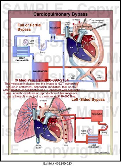 cardiopulmonary-bypass-medical-illustration-medivisuals