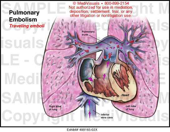 Medivisuals Pulmonary Embolism Medical Illustration