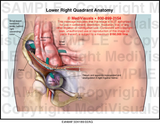 Lower Right Quadrant Anatomy Medical Exhibit