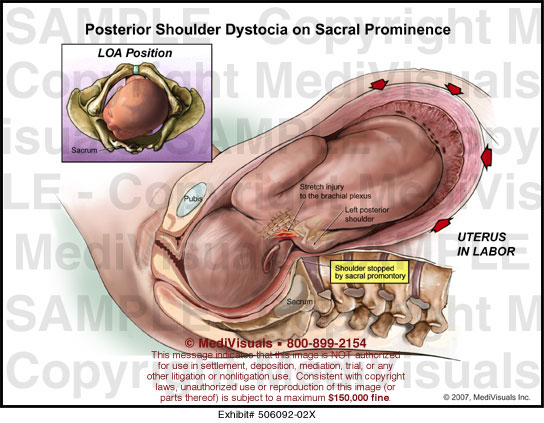 shoulder dystocia brachial plexus injury