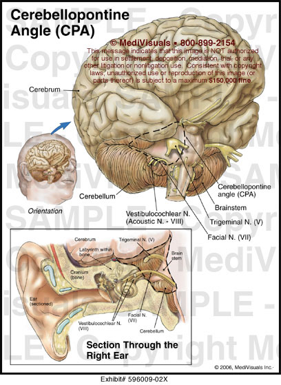 Cerebellopontine Angle (CPA) Medical Illustration Medivisuals