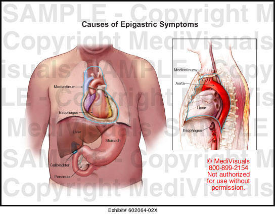 causes-of-epigastric-symptoms-medical-illustration-medivisuals