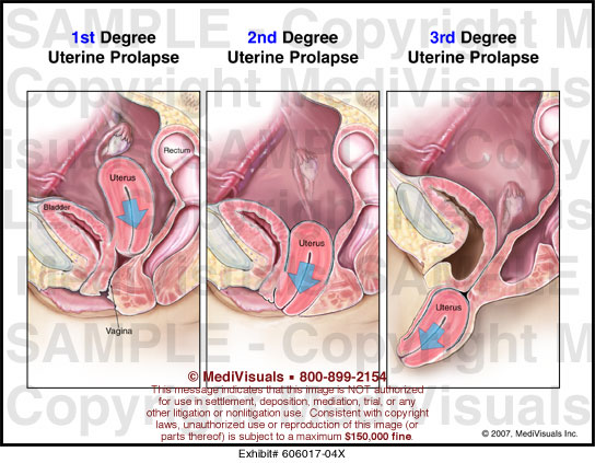 Degrees Of Uterine Prolapse Medical Illustration MediVisuals