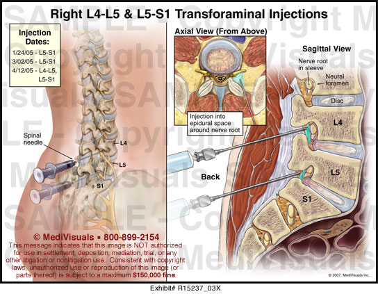 day-6-after-l4-l5-microdiscectomy-lumbar-back-surgery-for-slipped