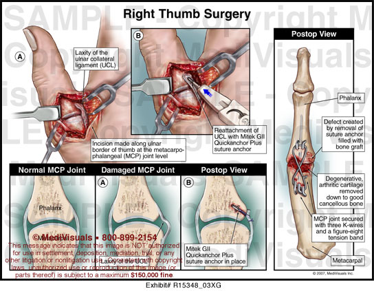 Right Thumb Surgery MediVisuals Medical Illustration
