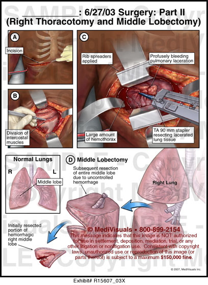 Surgery Part II - Right Thoracotomy and Middle Lobectomy - R15607_03X
