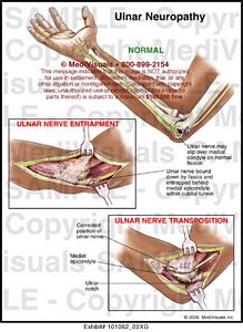 Ulnar Neuropathy Medical Illustration Medivisuals