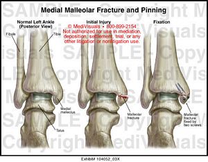 Medial Malleolar Fracture and Pinning Medical Exhibit