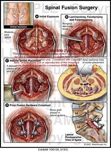 Medivisuals Spinal Fusion Surgery Medical Illustration