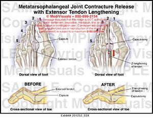 joint tendon extensor release lengthening contracture 03x illustration medivisuals1