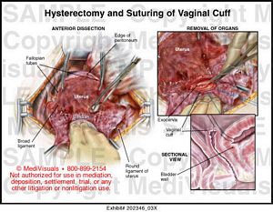 Hysterectomy and Suturing of Vaginal Cuff Medical Exhibit Medivisuals