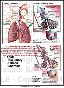 respiratory distress syndrome acute medivisuals1