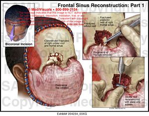 Frontal Sinus Reconstruction Surgery: Part 1 Medical Illustration