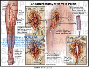 Endarterectomy Medical Illustration Medivisuals