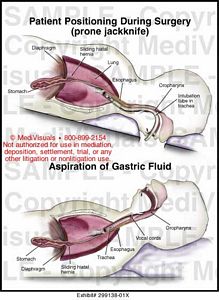 Medivisuals Prone Jackknife Position And Aspiration Of Gastric Fluid