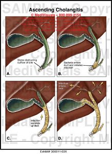 Ascending Cholangitis Medical Illustration Medivisuals